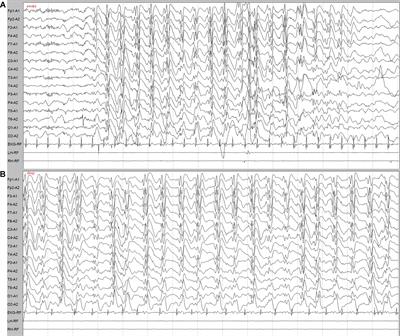 Novel Truncating and Missense Variants in SEMA6B in Patients With Early-Onset Epilepsy